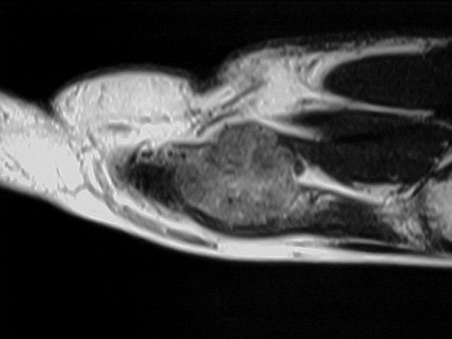 Figure 4 for case Glomus tumors
